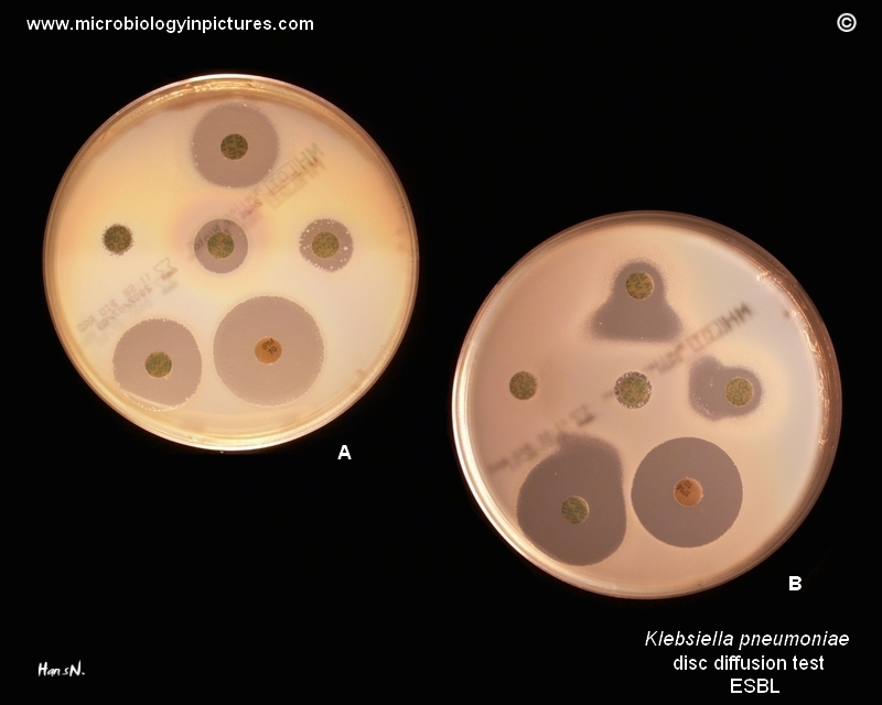 Klebsiella Pneumoniae Esbl