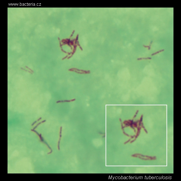 Mycobacterium Tuberculosis Ziehl Neelsen Stain Acid Fast Bacteria