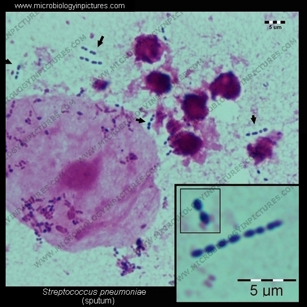pneumococcus micrograph, Gram stain